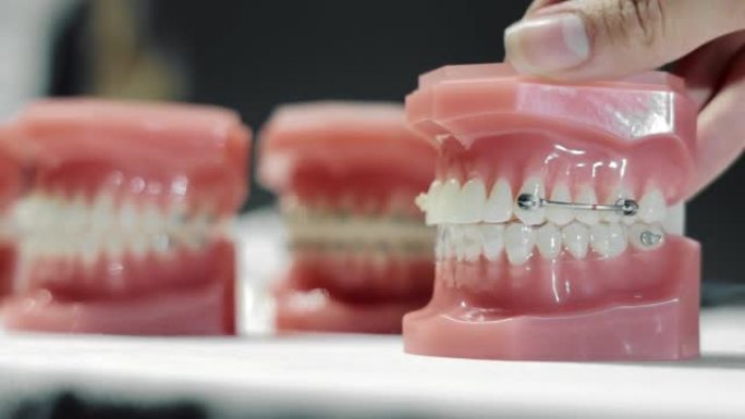 牙齿间隙在正畸托槽放置上的模型。在不同布局上放置和固定正畸医生的变体。牙齿异常