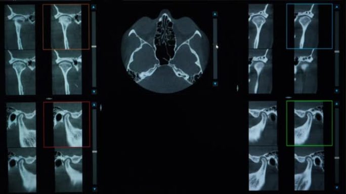 1例错牙合、牙齿缺失和颞下颌关节功能障碍患者的ct扫描。