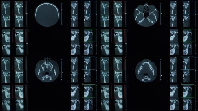 1例错牙合、牙齿缺失和颞下颌关节功能障碍患者的ct扫描。