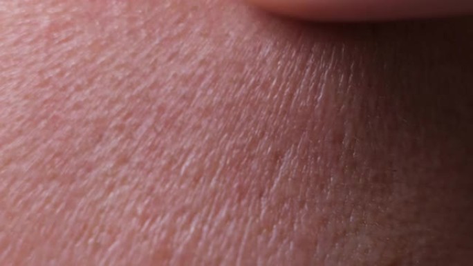 人类皮肤。特写。常见的皮肤疾病包括: 痤疮，皮肤毛囊阻塞，导致油脂，细菌和死皮在毛孔中积聚