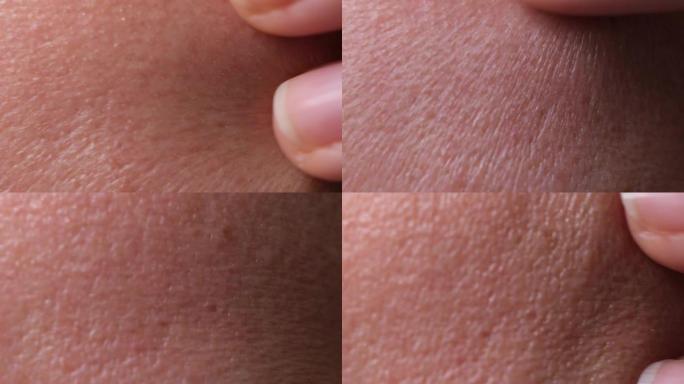 人类皮肤。特写。常见的皮肤疾病包括: 痤疮，皮肤毛囊阻塞，导致油脂，细菌和死皮在毛孔中积聚
