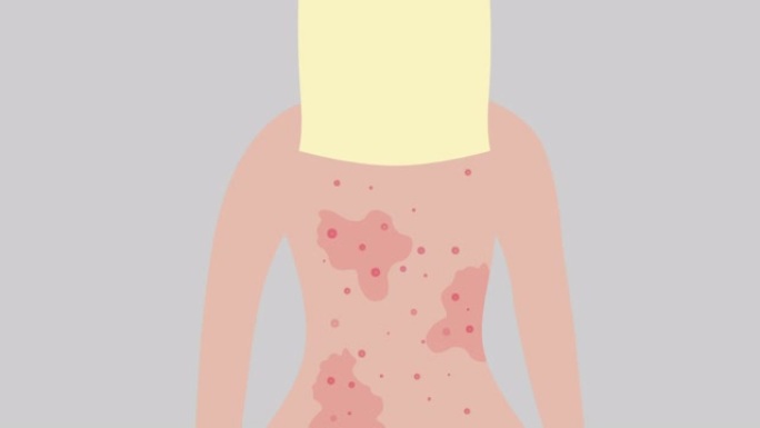 女人背上有粉刺。治疗过敏，皮肤问题概念。