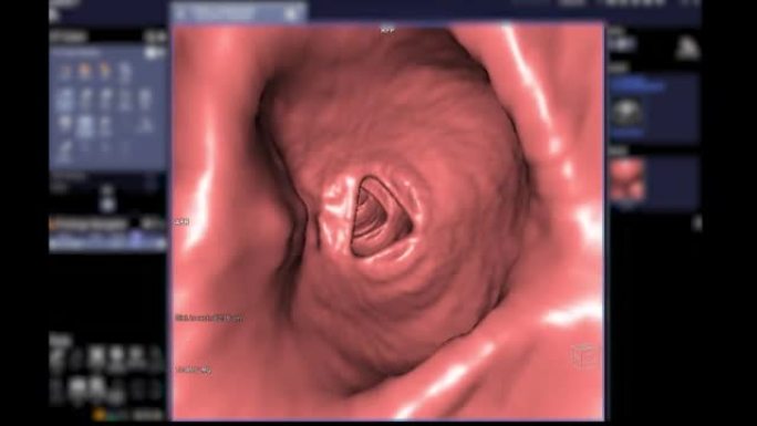 CT结肠造影3D渲染镜头。
