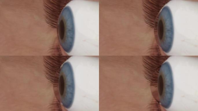 眼睛的圆锥角膜。圆锥形的角膜曲率，视力模糊，散光。圆锥角膜运动视频的生长和曲率的宏观特写。
