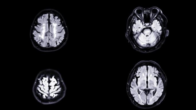 脑部核磁共振成像。