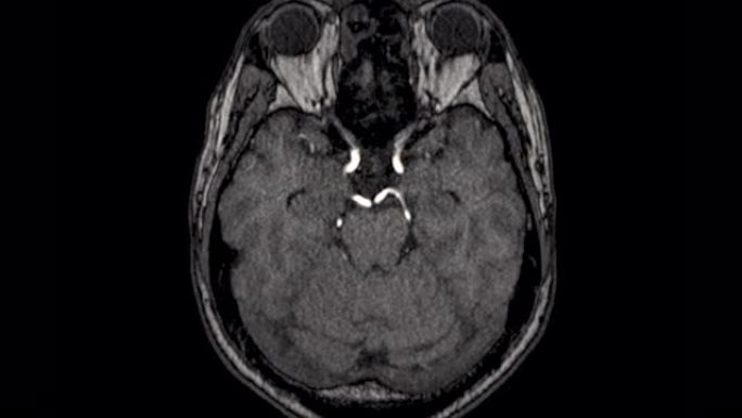 MRA脑或脑动脉磁共振血管造影