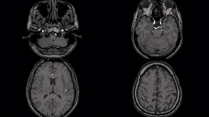 MRA脑或脑动脉磁共振血管造影