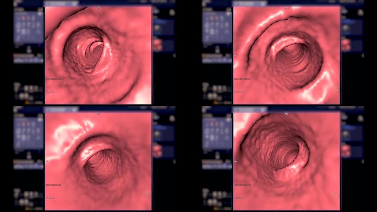 CT结肠造影3D渲染镜头。