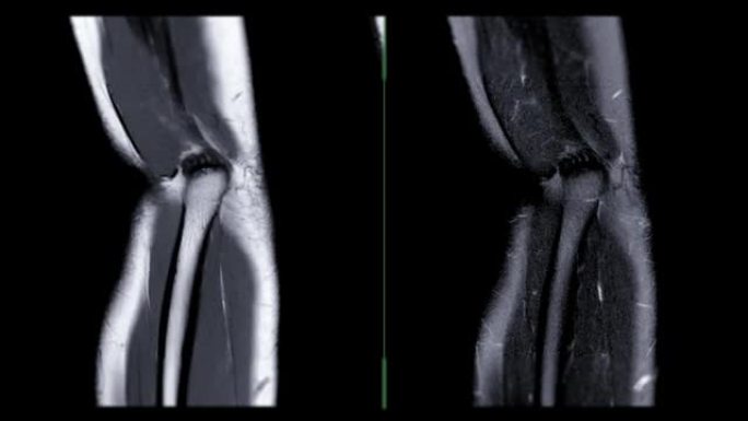 MRI肘关节。