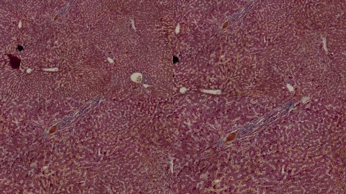 显微镜下有肿块和肿胀的人肝硬化的显微照片