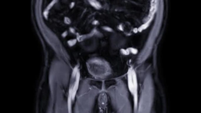 MRI前列腺。
