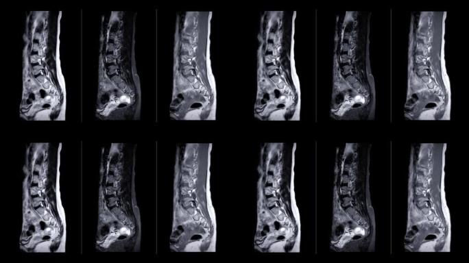 MRI l-s脊柱