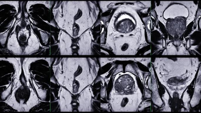 MRI前列腺。