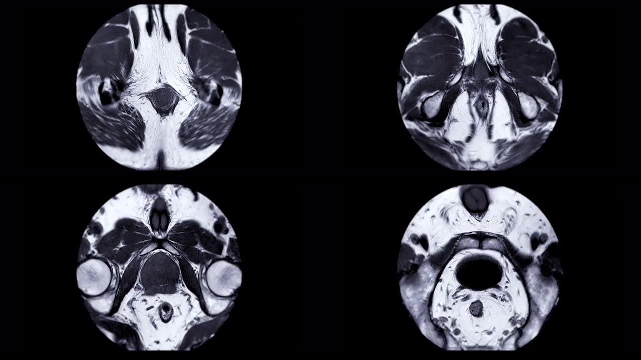 老年男性前列腺MRI诊断前列腺癌细胞。