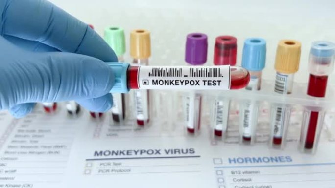 实验室技术员助理或医生持有验血超过猴痘病毒测试申请报告