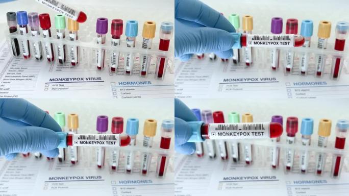 实验室技术员助理或医生持有验血超过猴痘病毒测试申请报告