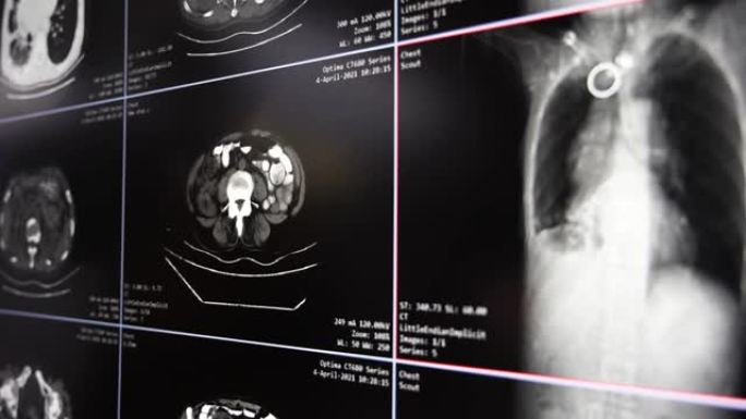 MRI腹腔体层摄影术