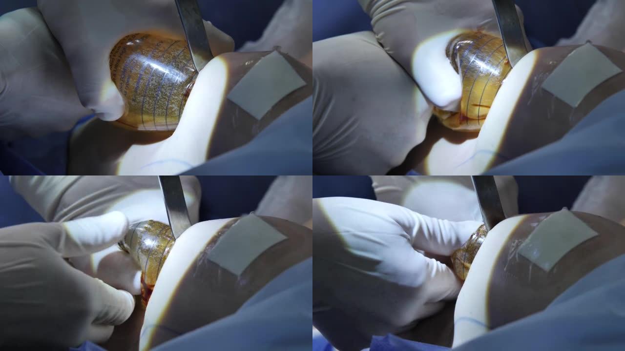 整形手术。外科医生安装无菌硅胶乳房植入物隆胸手术特写