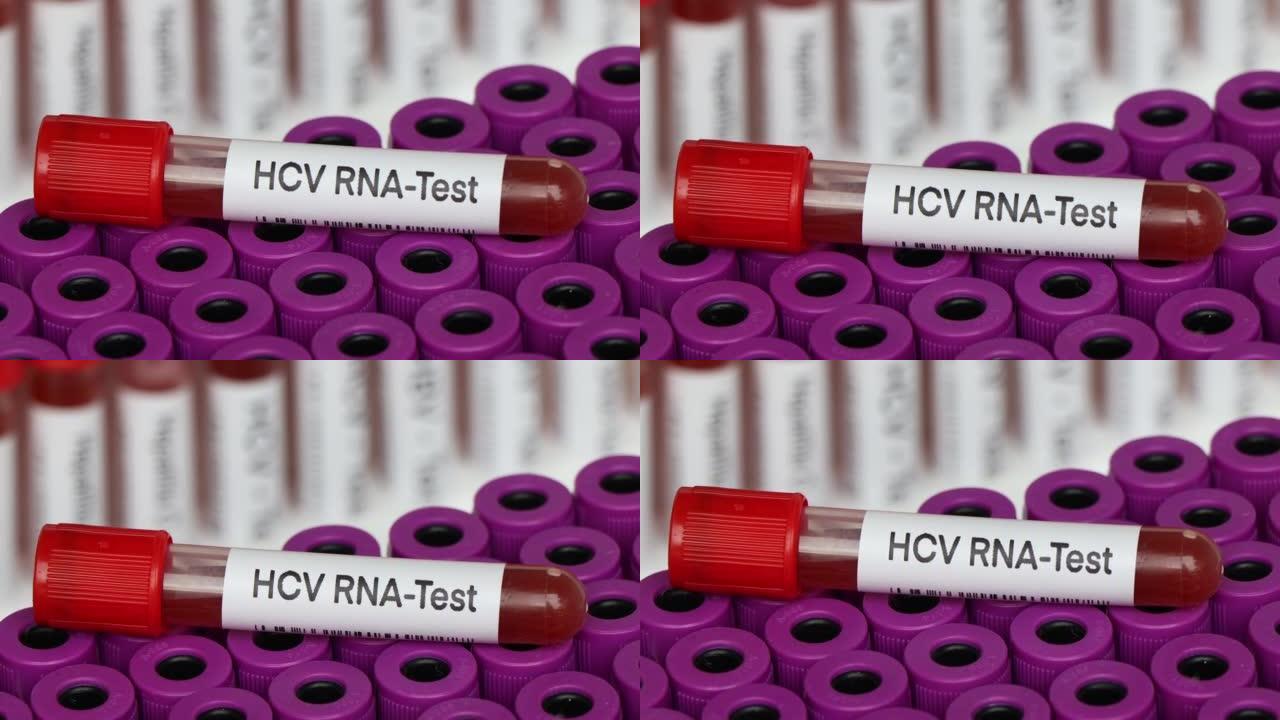 HCV RNA检测从血液中寻找异常