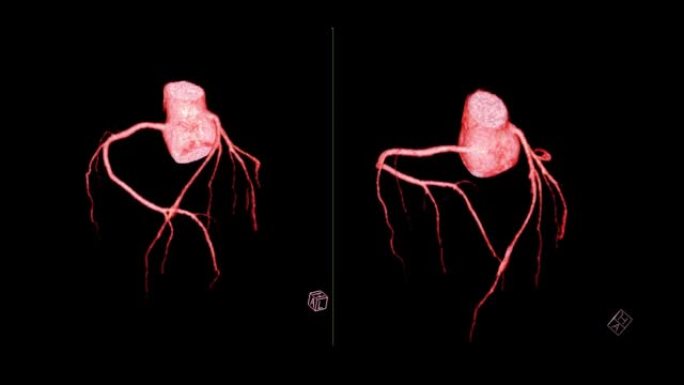 CTA冠状动脉三维渲染。