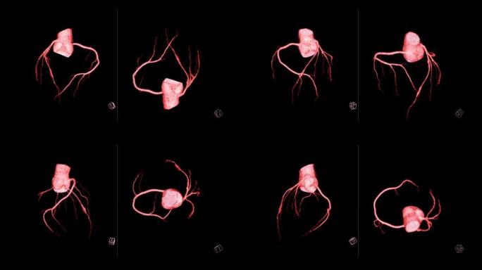 CTA冠状动脉三维渲染。