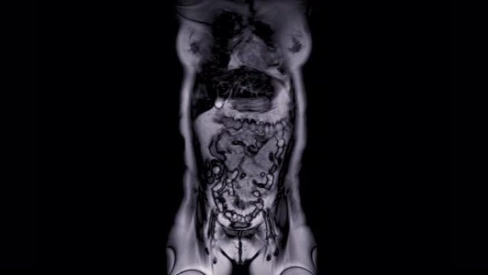 MRI全腹部冠状T2视图