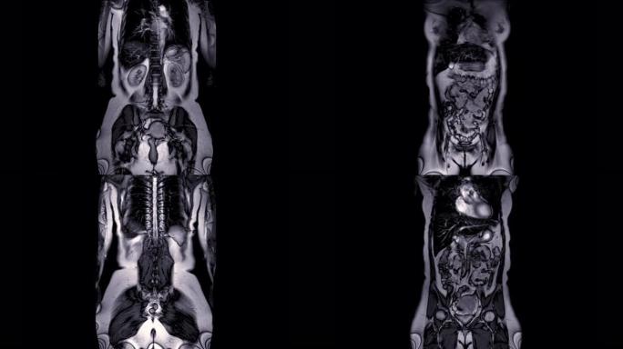 MRI全腹部冠状T2视图