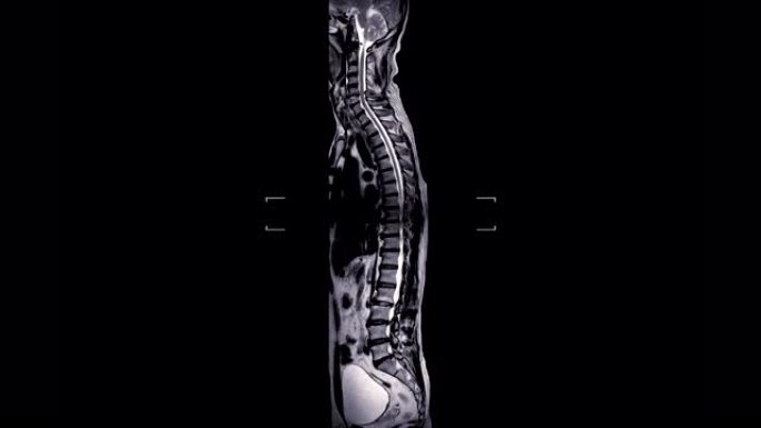 MRI筛查整个脊柱。