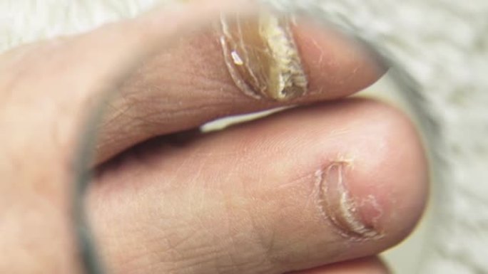 一名男子用放大镜检查受真菌影响的脚趾甲。