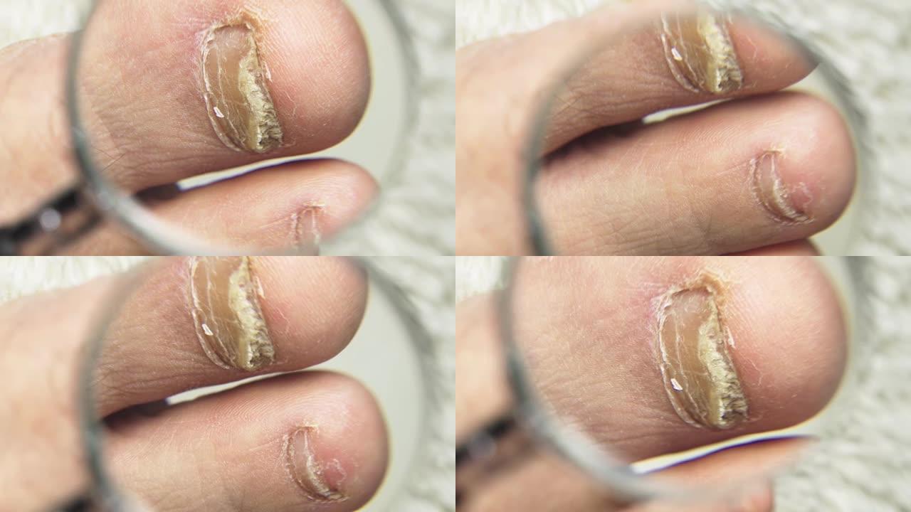 一名男子用放大镜检查受真菌影响的脚趾甲。