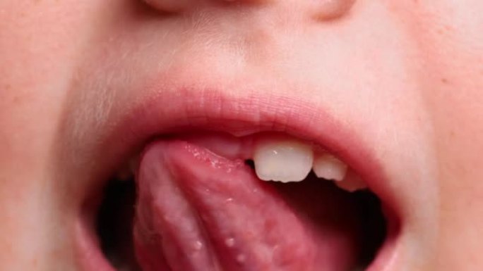 特写儿童无牙口的视频，显示牙齿和牙龈缺失的牙齿。弯曲，不稳定的牙齿护理
