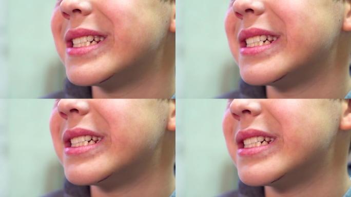 这个男孩露出了牙齿。额外的尖牙生长