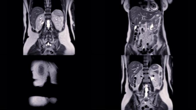 MRI上腹部用于诊断肝肿瘤或肝细胞癌 (HCC)。