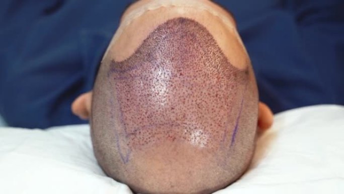 头发移植手术后头皮的俯视图