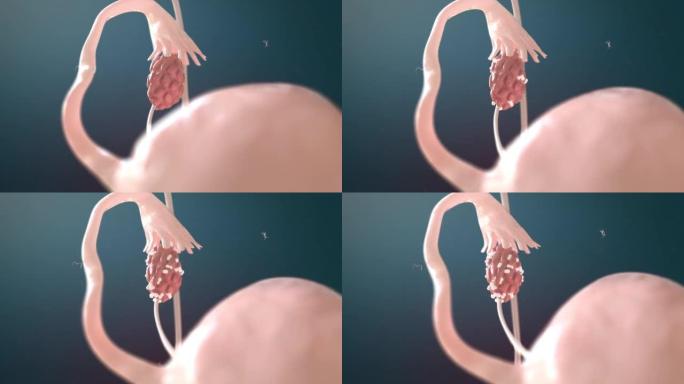 卵巢囊肿女性生殖系统