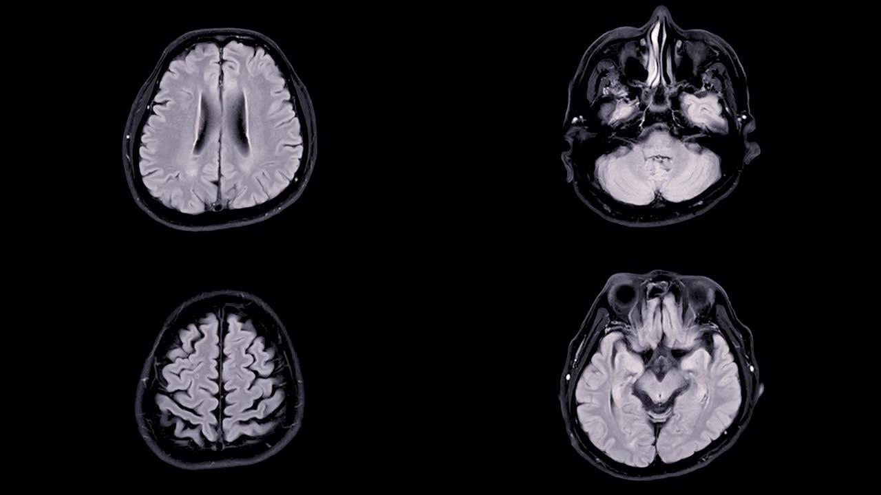 脑部核磁共振成像。