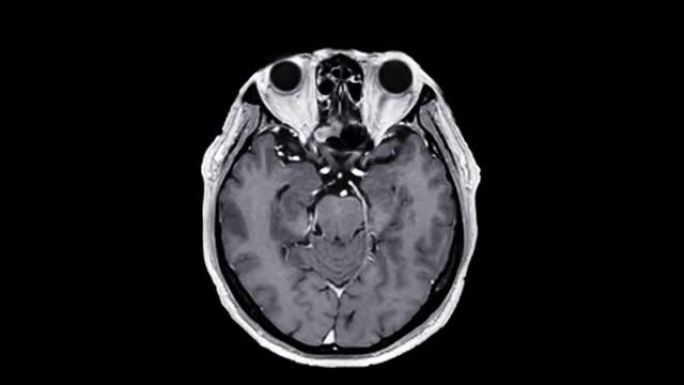 脑部核磁共振成像。