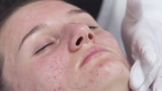美容师在美容水疗中心对患有痤疮问题皮肤的年轻女性脸上使用特殊的酸性凝胶