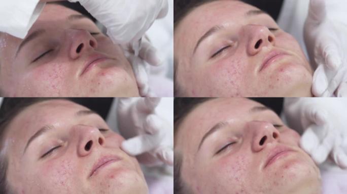 美容师在美容水疗中心对患有痤疮问题皮肤的年轻女性脸上使用特殊的酸性凝胶