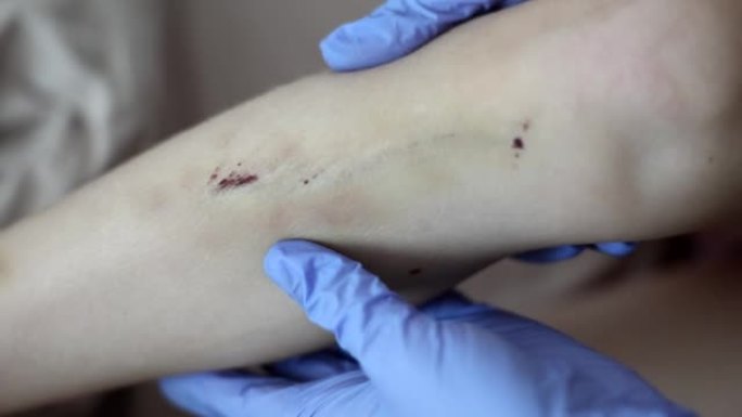 创伤科医生检查腿部有多处擦伤和血肿的儿童