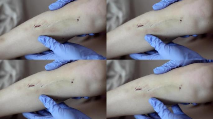 创伤科医生检查腿部有多处擦伤和血肿的儿童