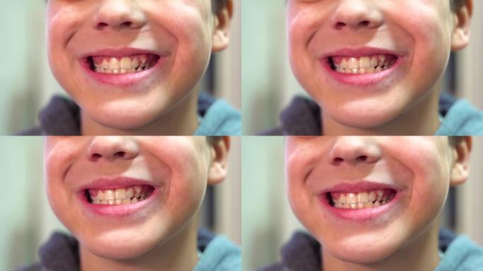 这个男孩露出了牙齿。额外的尖牙生长