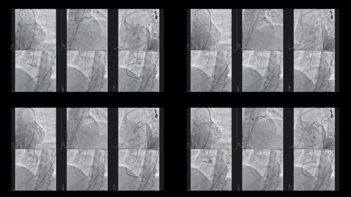 显示冠状动脉的心导管检查以诊断心脏骤停。