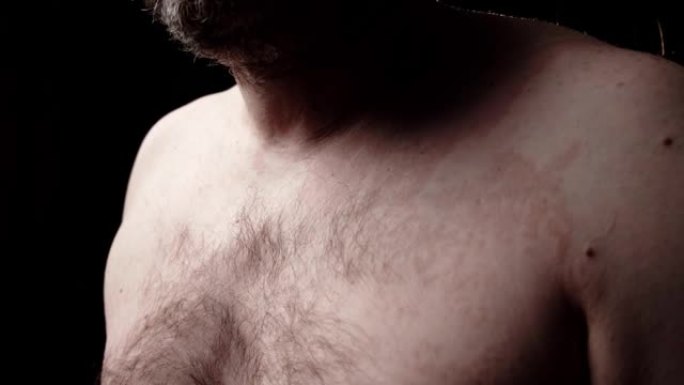 皮肤问题，带状疱疹。男性躯干有皮肤病变。皮肤护理，皮肤科。