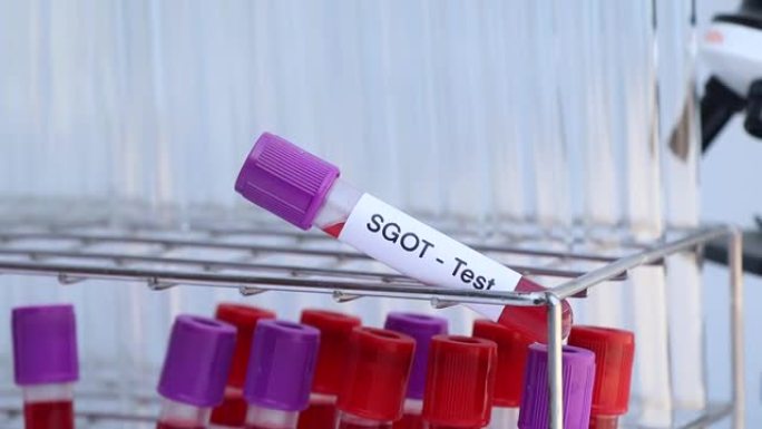 SGOT测试以寻找血液中的异常