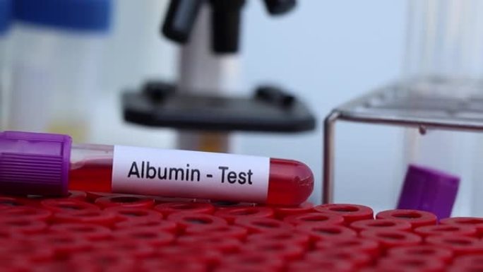 从血液中寻找异常的白蛋白测试
