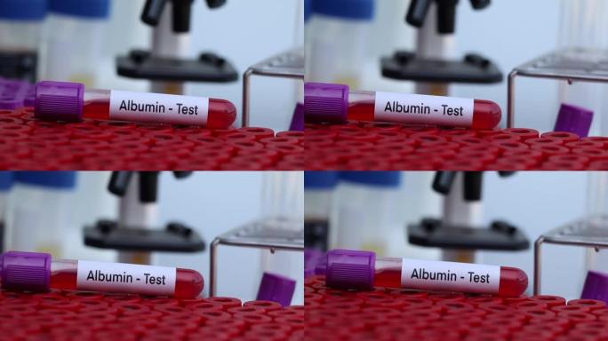 从血液中寻找异常的白蛋白测试