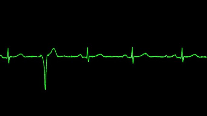 心电图显示室性早搏心律失常