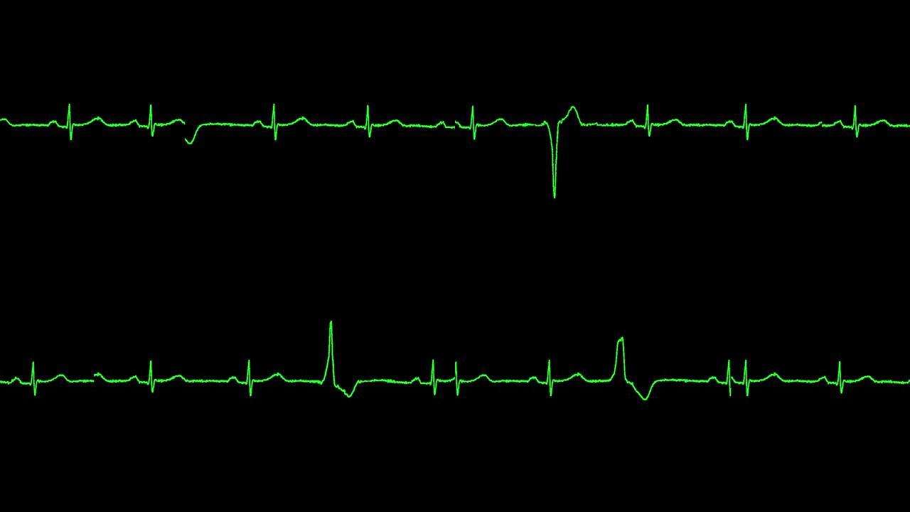 心电图显示室性早搏心律失常