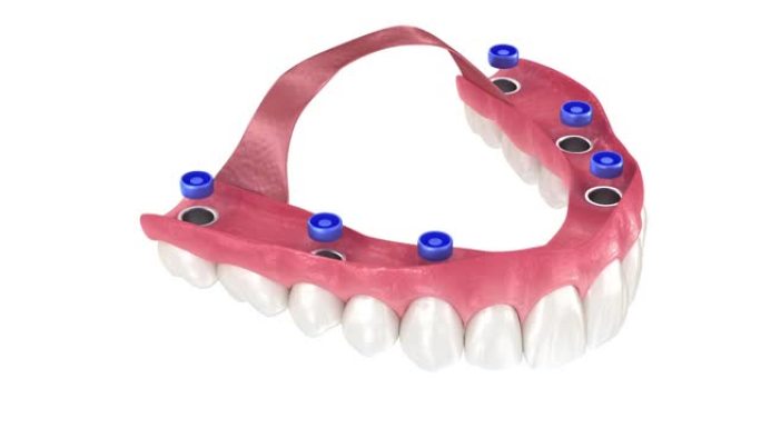 由植入物支持的6系统上的口香糖可移动假体。牙科3D动画